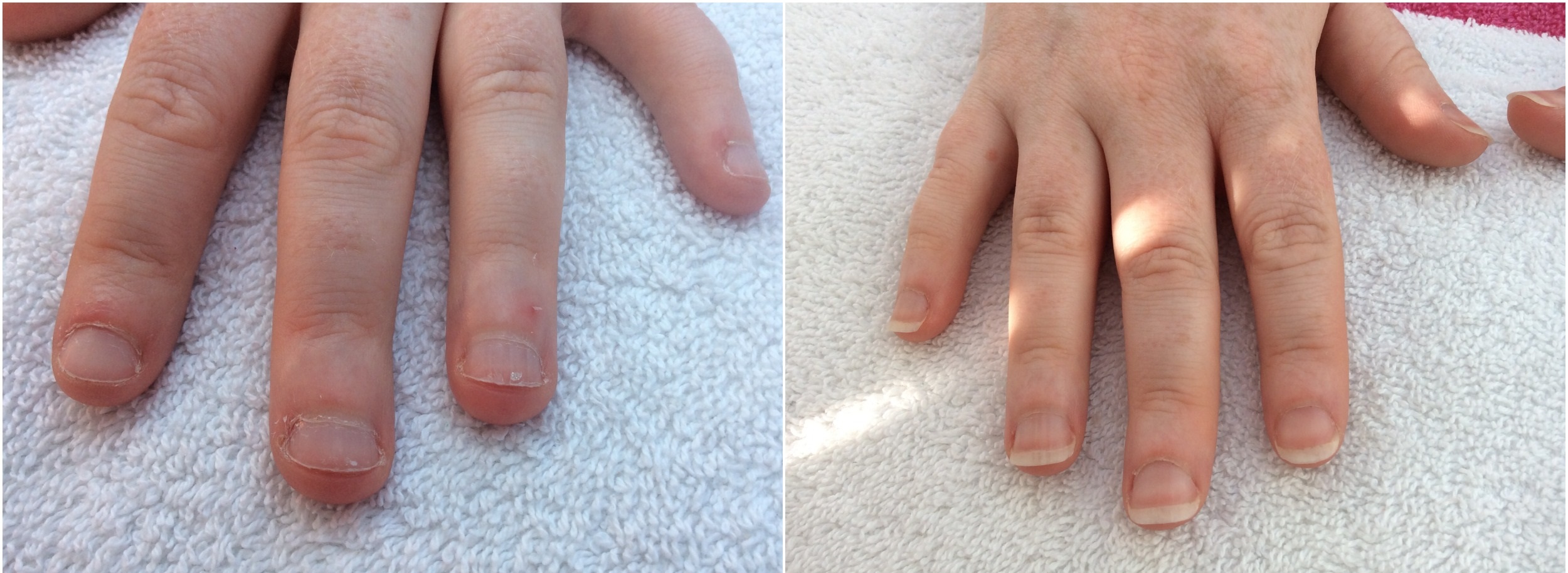 Before and After IBX nail treatment Marie-Louise Coster
