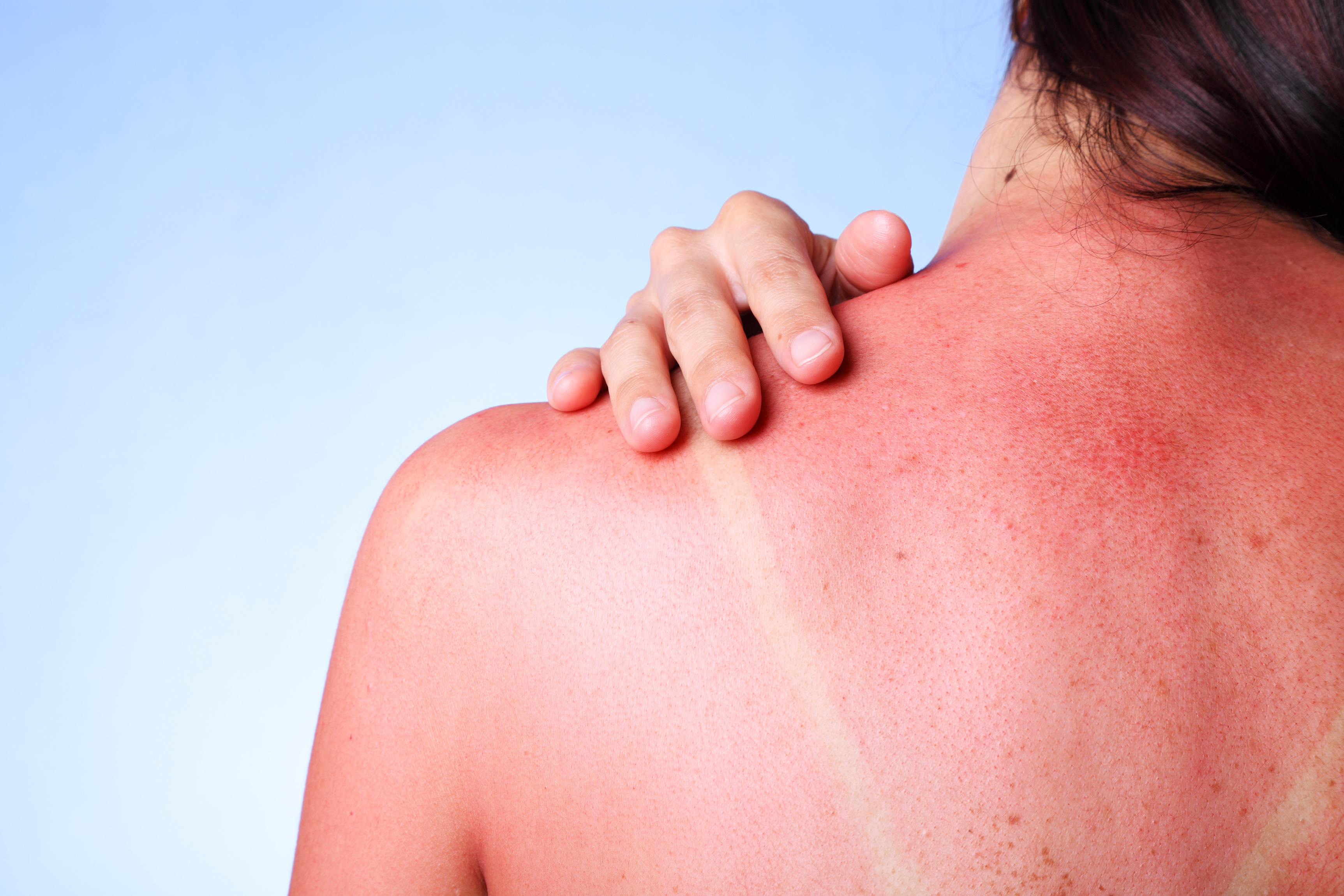 woman with sunburn