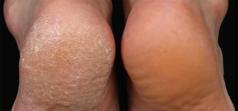 Beauty Select callus feet