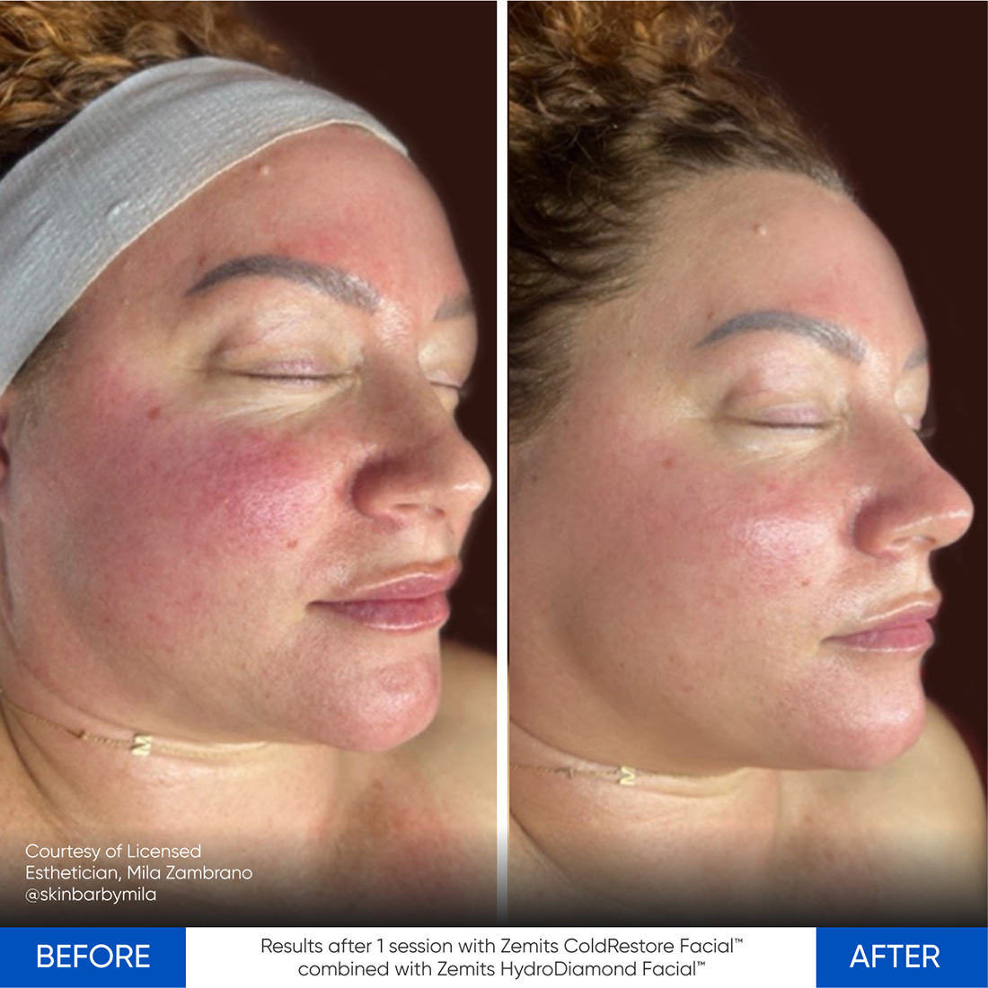 Case Study using Zemits CryoElegance