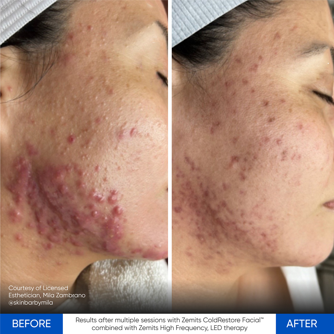 Case Study using Zemits CryoElegance