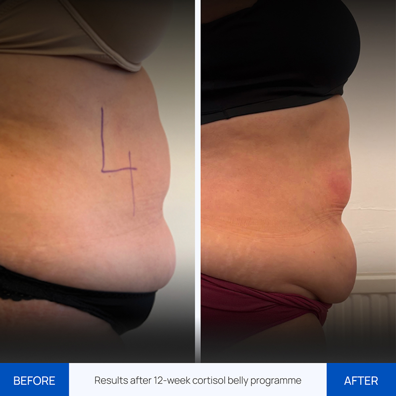 Before and after images Cortisol Belly by Zemits