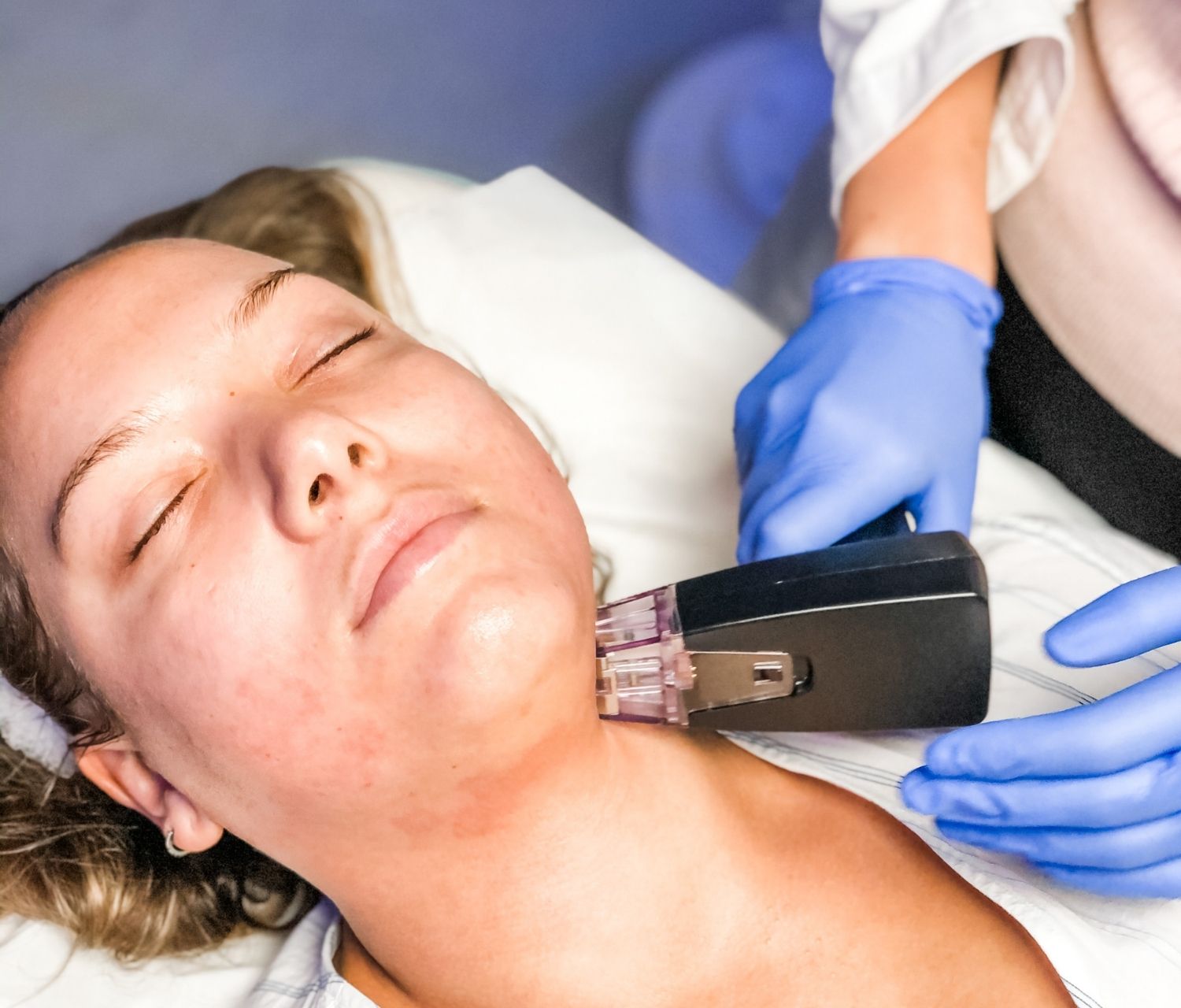 Morpheus8 Omniya Clinic