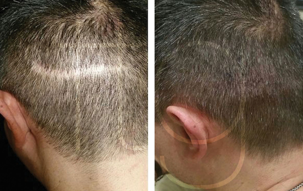 VYTAL Scalp Micropigmentation BeautyandHairdressing