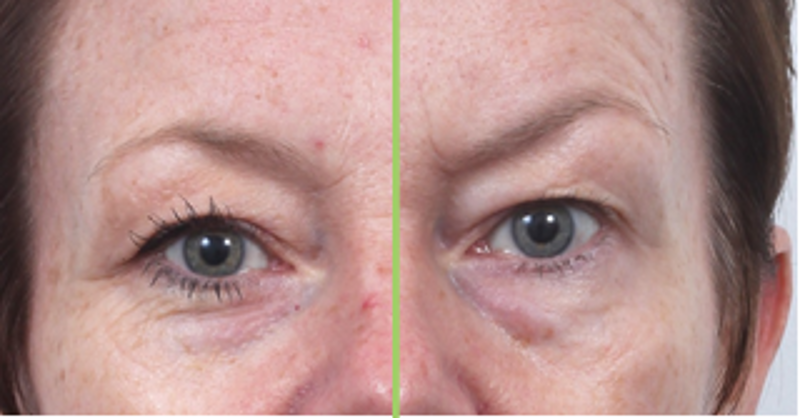 CACI SPED Before and After treatment