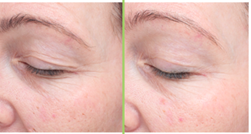 CACI SPED Before and After treatment