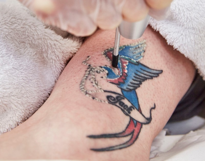 Report shows surge in tattoo removal demand