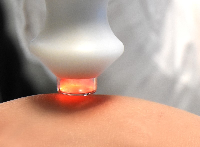 Skinbreeze Plasma Skin Tightening handpiece shot