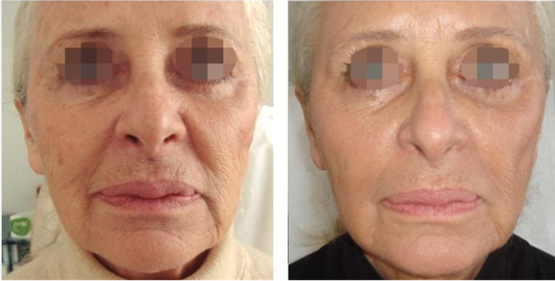 Advanced Esthetic Solutions The Pyramid Facial